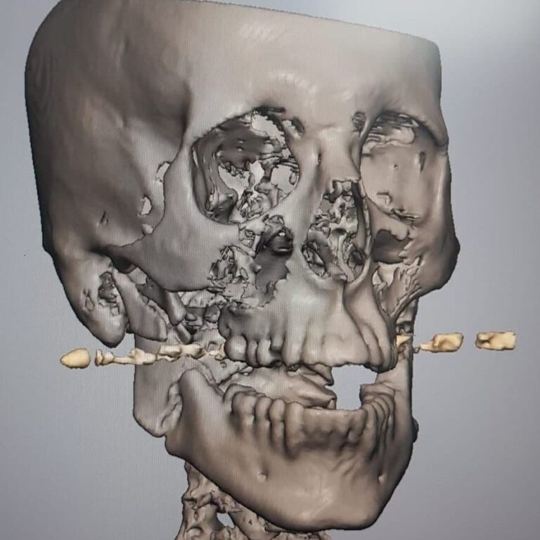 Rambam Doctors Reconstruct IDF Officer’s Shattered Jaw