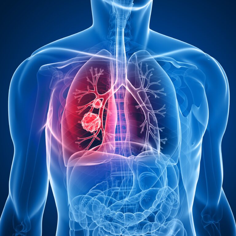 Fastest in the North, Fastest in Israel, and Fastest Worldwide – Lung Cancer Diagnosis at Rambam
