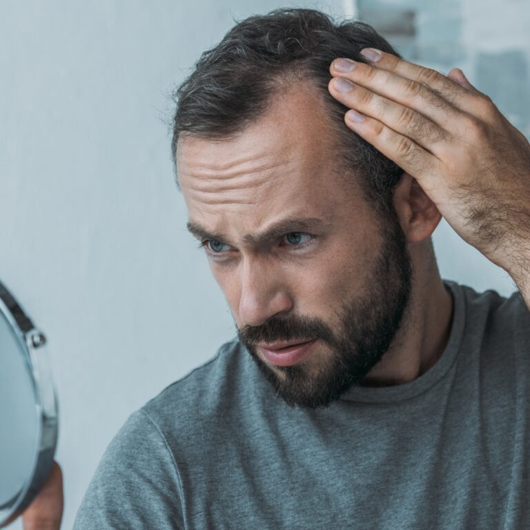 Alopecia – Forever Bald? Rambam-Technion Collaboration Reveals Better Treatment Could Be On The Way