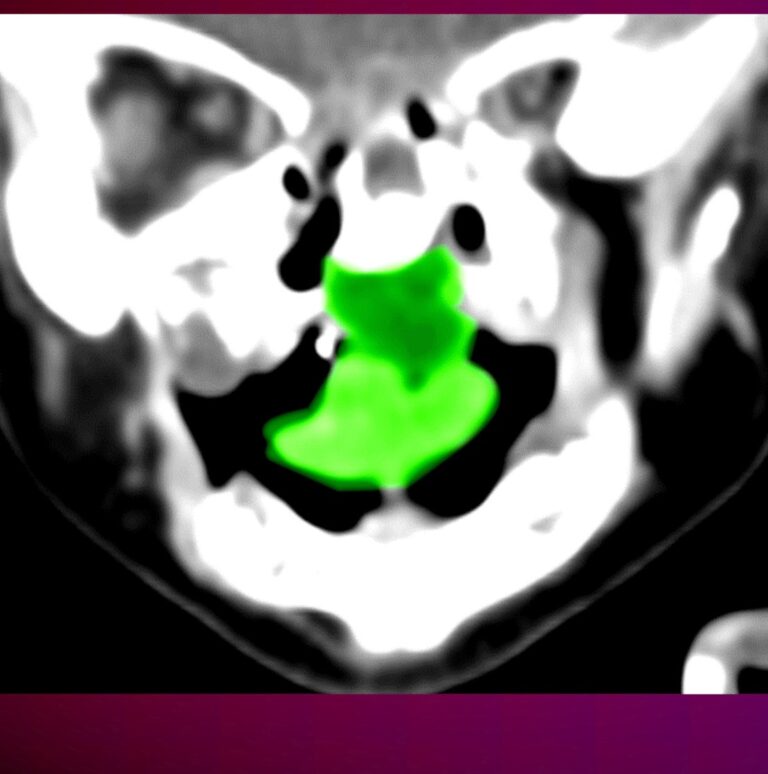 Rare Tumor Removed From One-Month-Old at Rambam