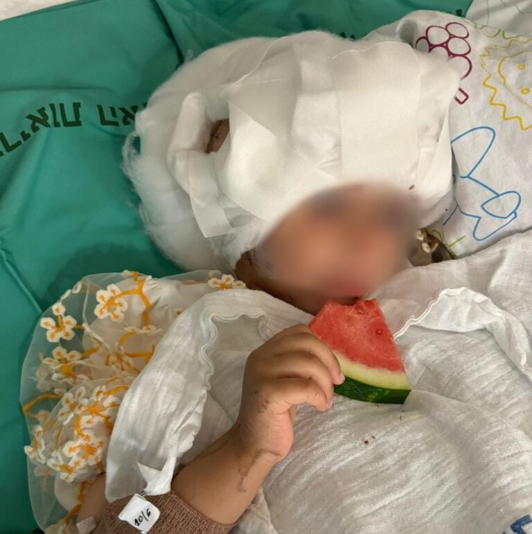 Rambam Surgeons Use Thigh Tissue in Complex Pediatric Skull Reconstruction Surgery