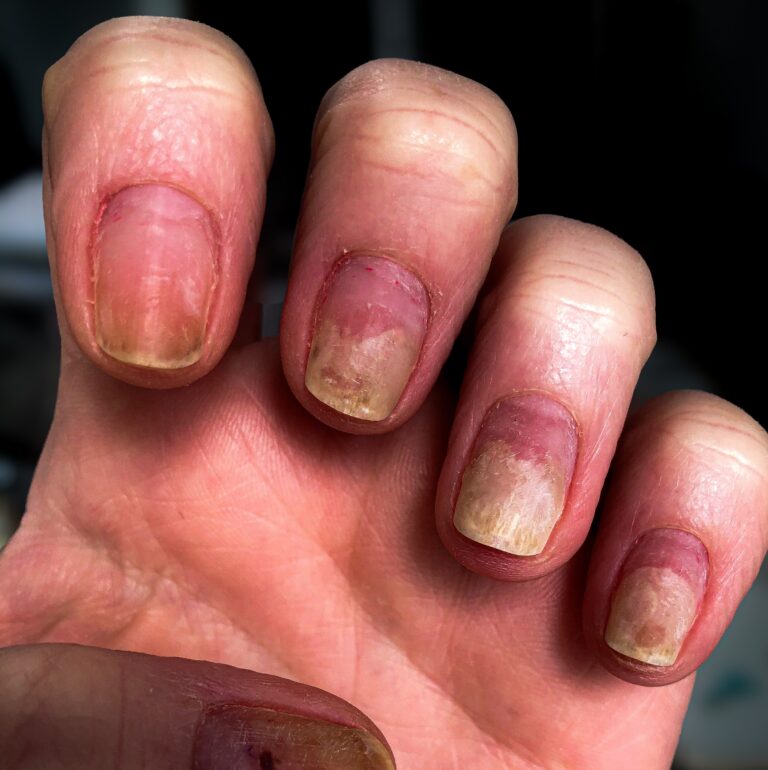 Rambam Study Sheds Light on Reactions to Gel Nail Polish