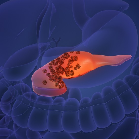 Can mRNA Vaccines Help Fight Pancreatic Cancer? A Rambam Expert’s Perspective